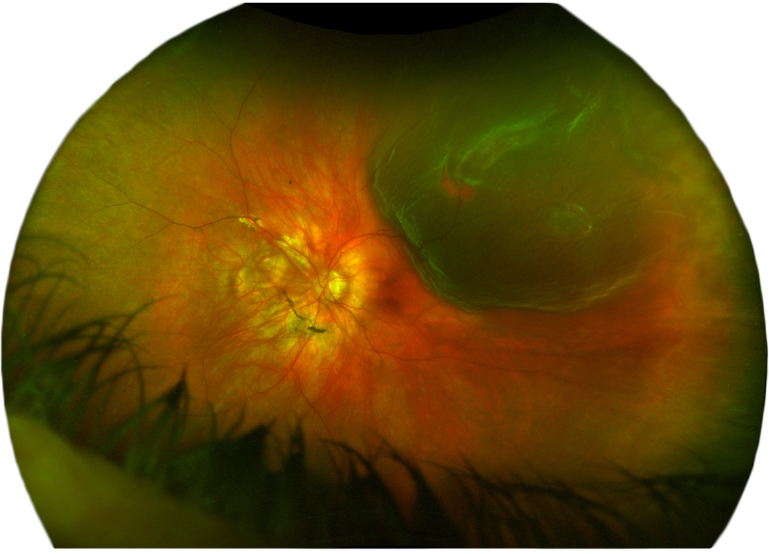 Fond d’oeil_Décollement rétine supérieur avec déchirure rétinienne